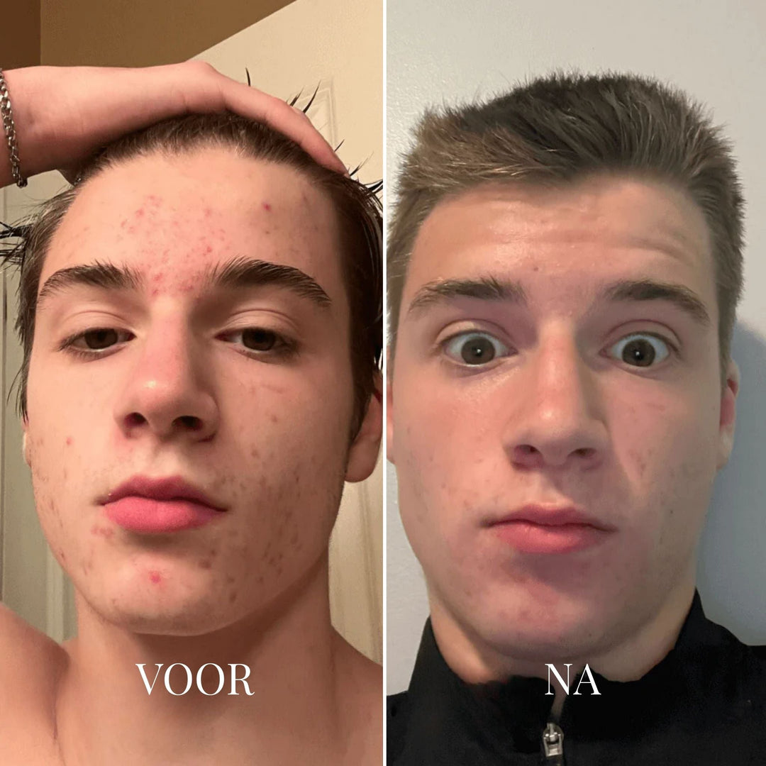 Porify Mee-eter Verwijderaar