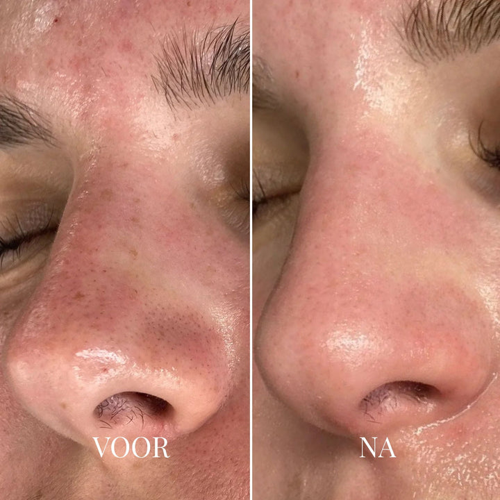 Porify Mee-eter Verwijderaar