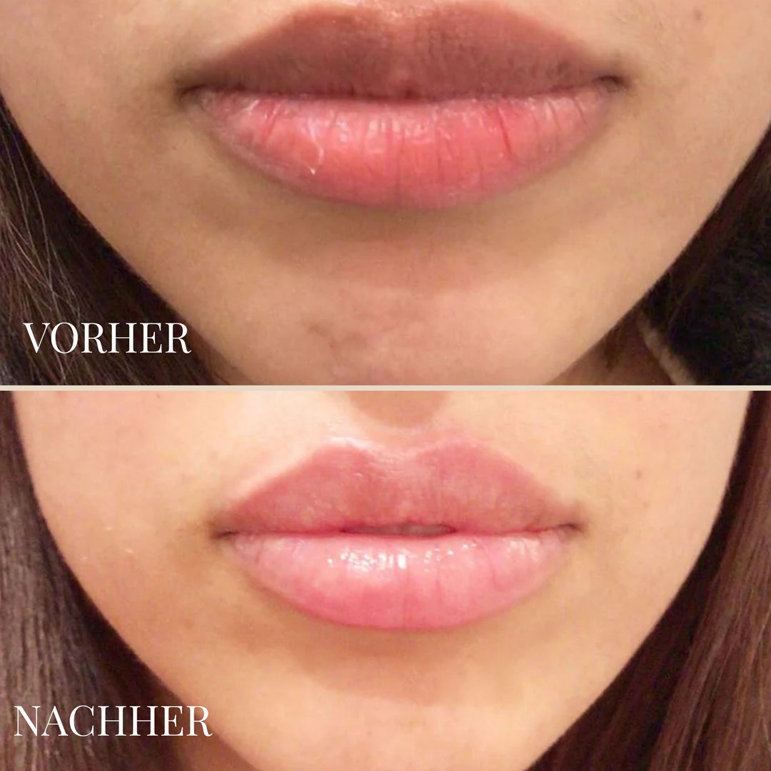 LEMON LIP BALM | DUNKLE LIPPEN NATÜRLICH AUFHELLEN