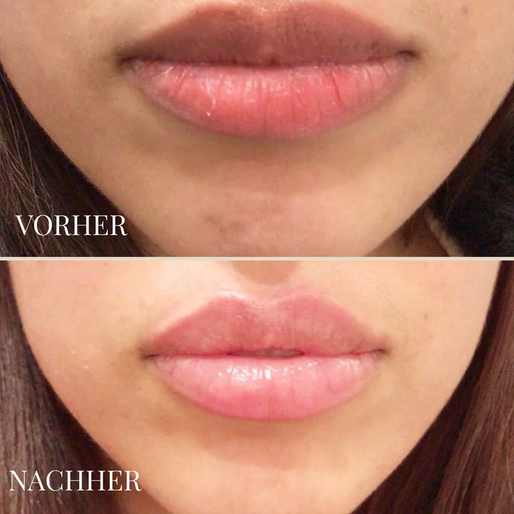 LEMON LIP BALM | DUNKLE LIPPEN NATÜRLICH AUFHELLEN
