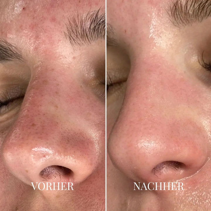 Porify Mee-eter Verwijderaar