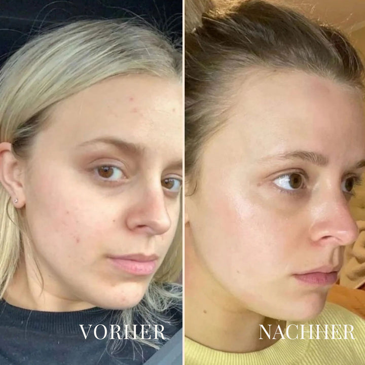 PeachAway Gesichtshaarentferner