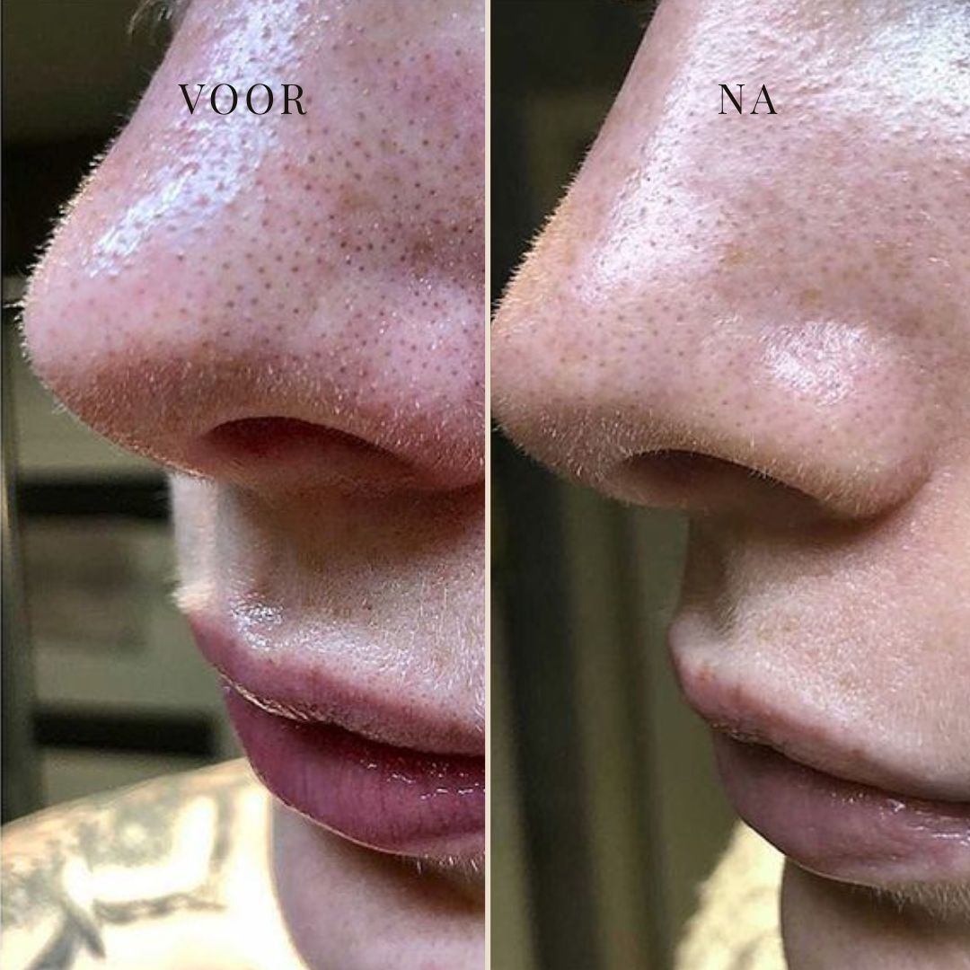 CLEARSILK | NASENMASKE GEGEN TALG